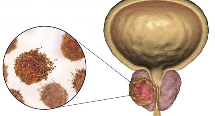Prostat ve prostattaki tümör hücrelerini gösteren çizim